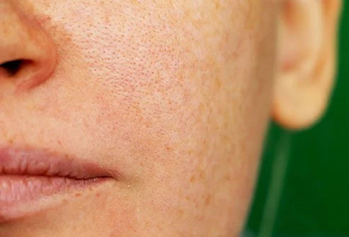 Melasma